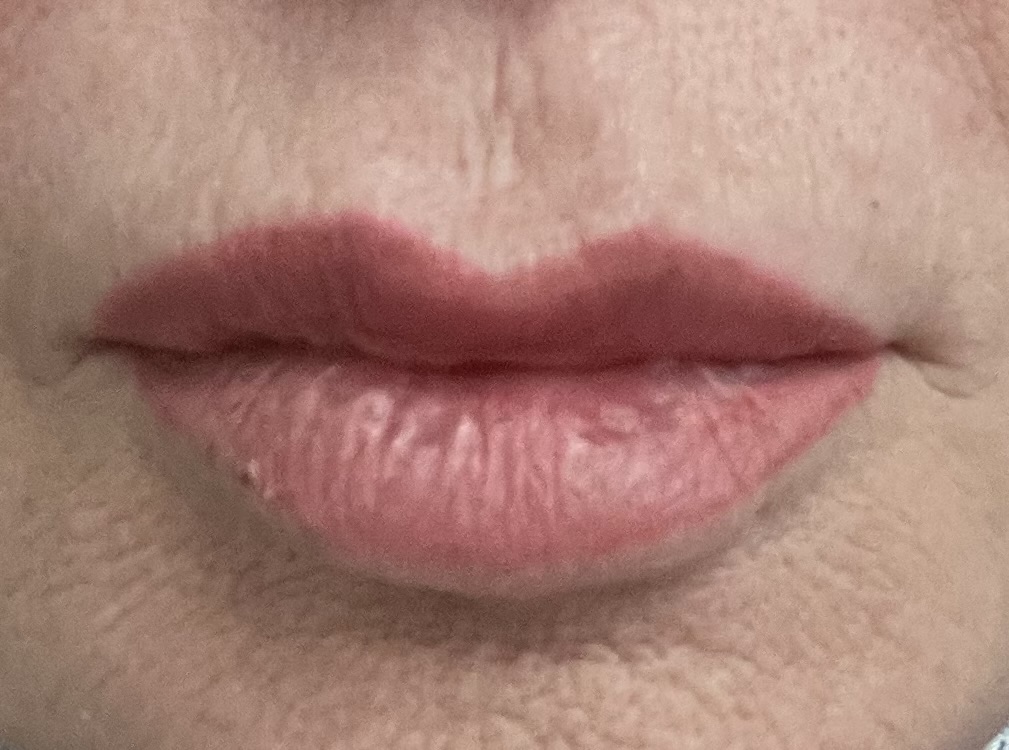 After lip filler