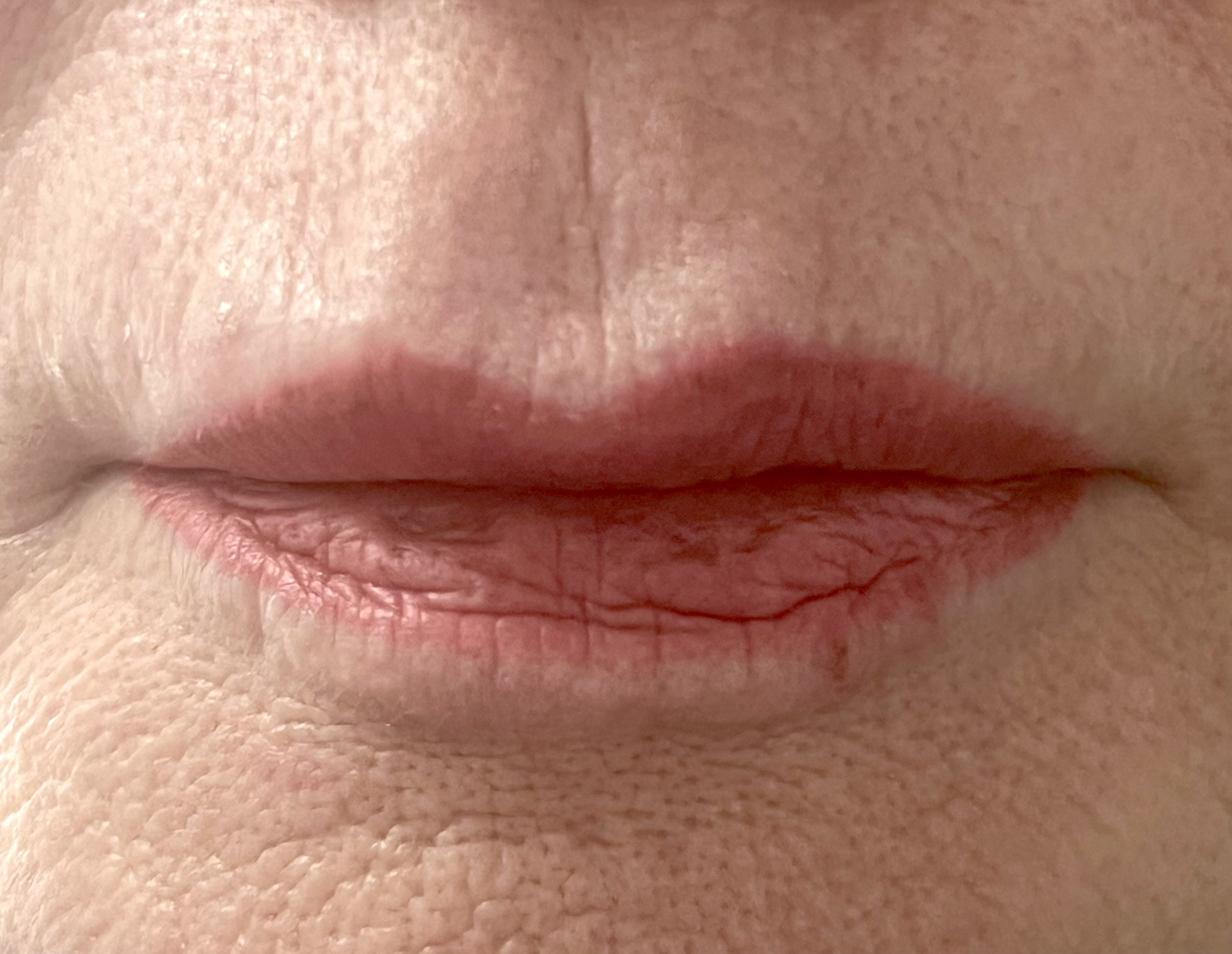 Before lip filler