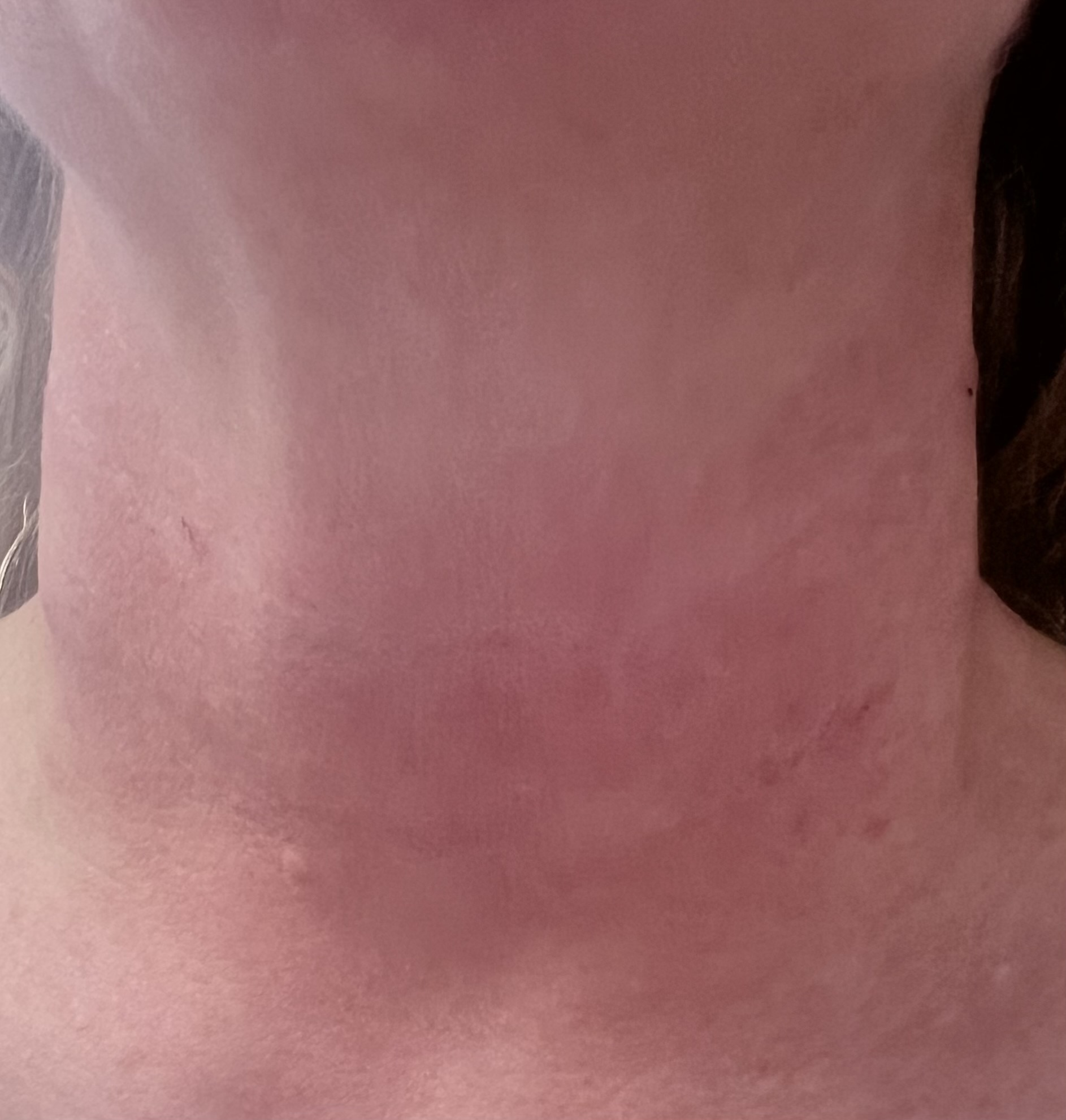 After Radiesse neck