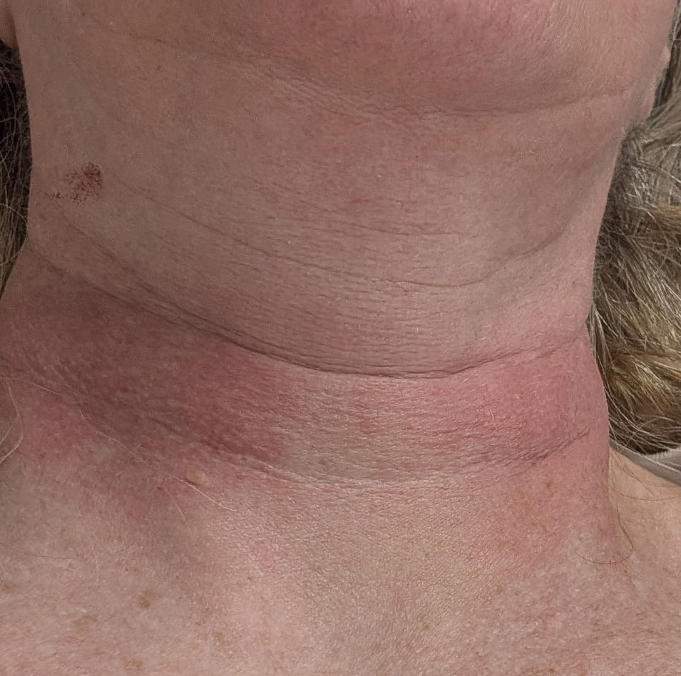 Before Radiesse neck